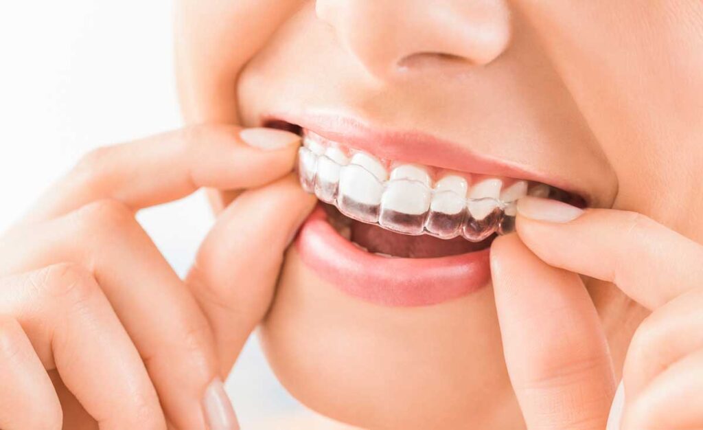 the different types of braces you can get at Oldbury Smile Spa Birmingham