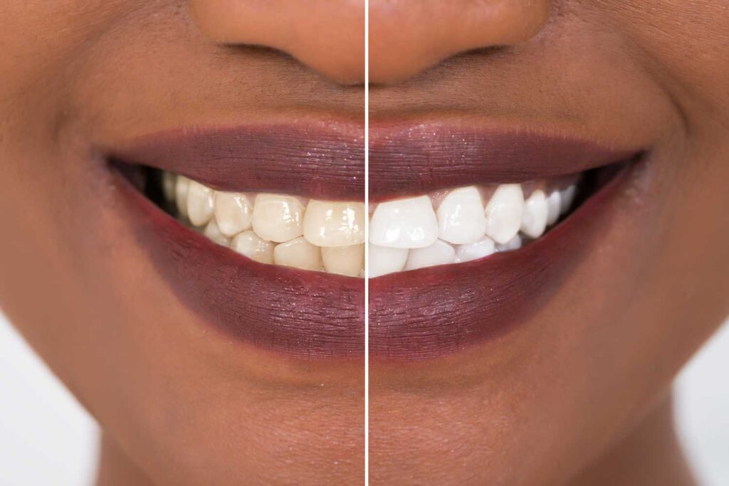 options for whiter teeth Oldbury smile spa