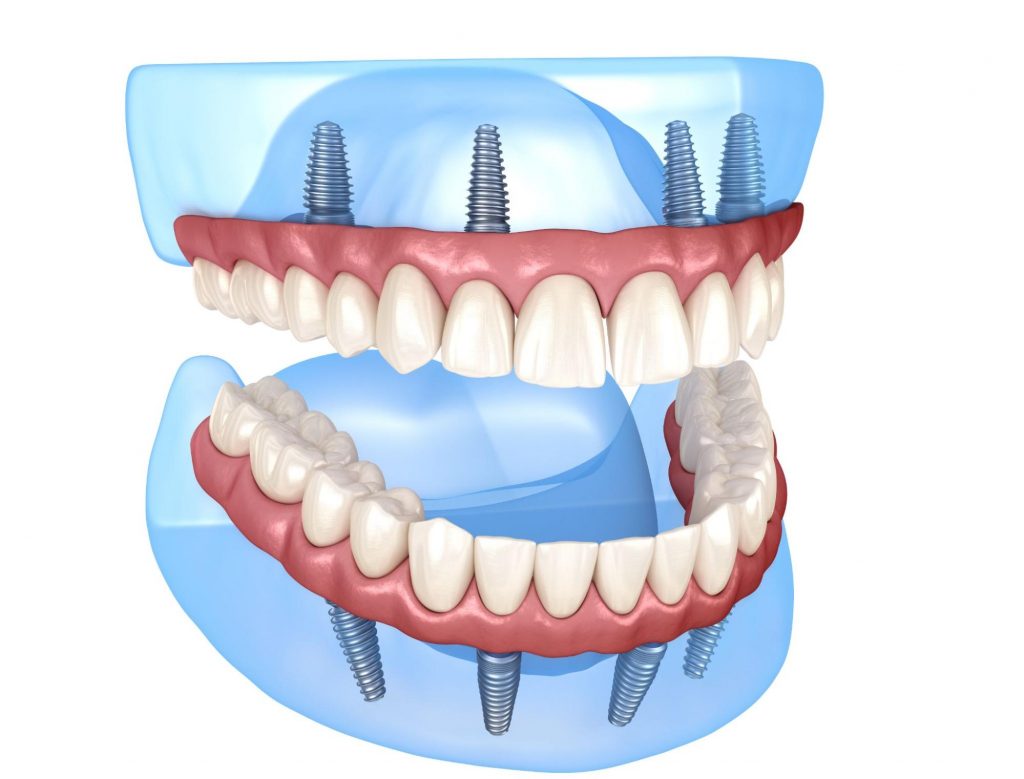 here is a image of a 3d picture of dental implants