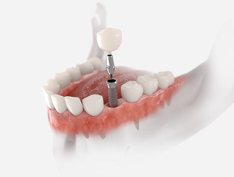 Premolar teeth implant 