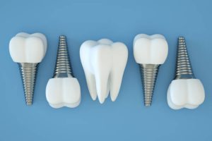 How long does dental implants last