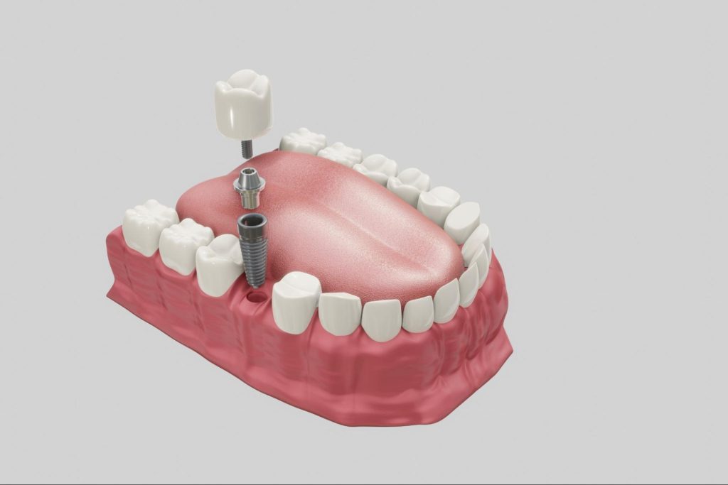 Dental Implants Oldbury