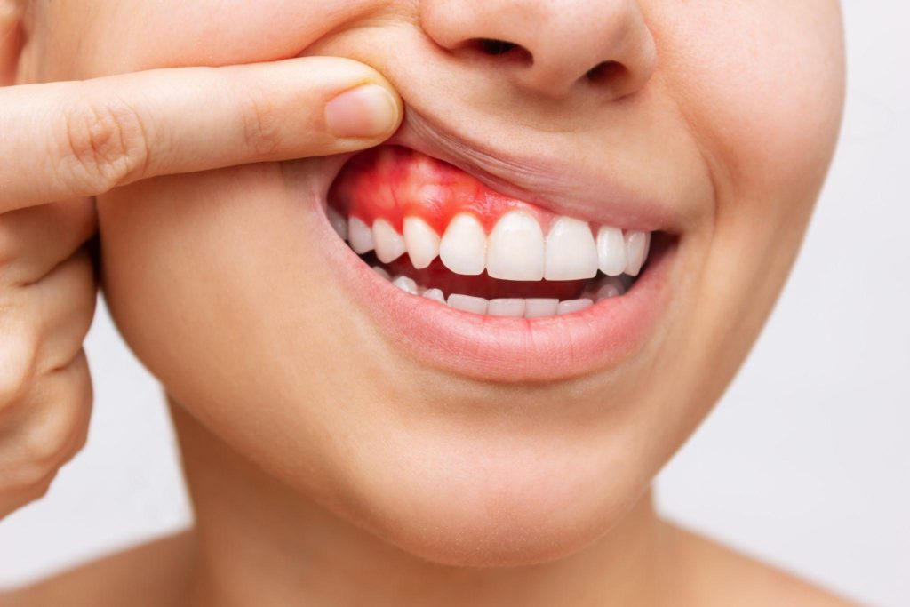 woman showing her gum disease above teeth