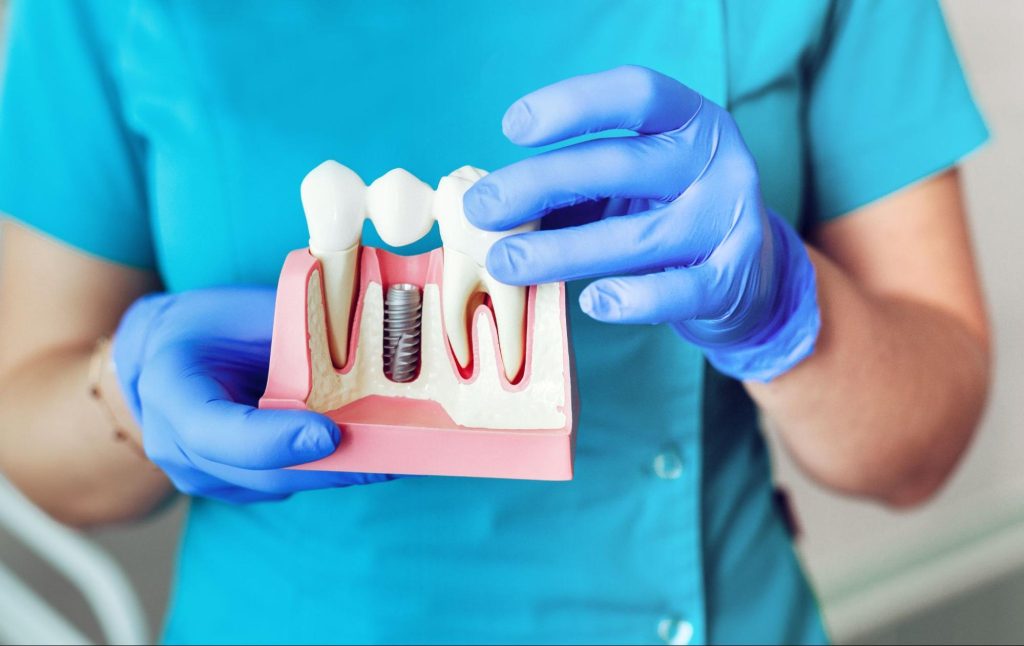 dentist holding dental implants