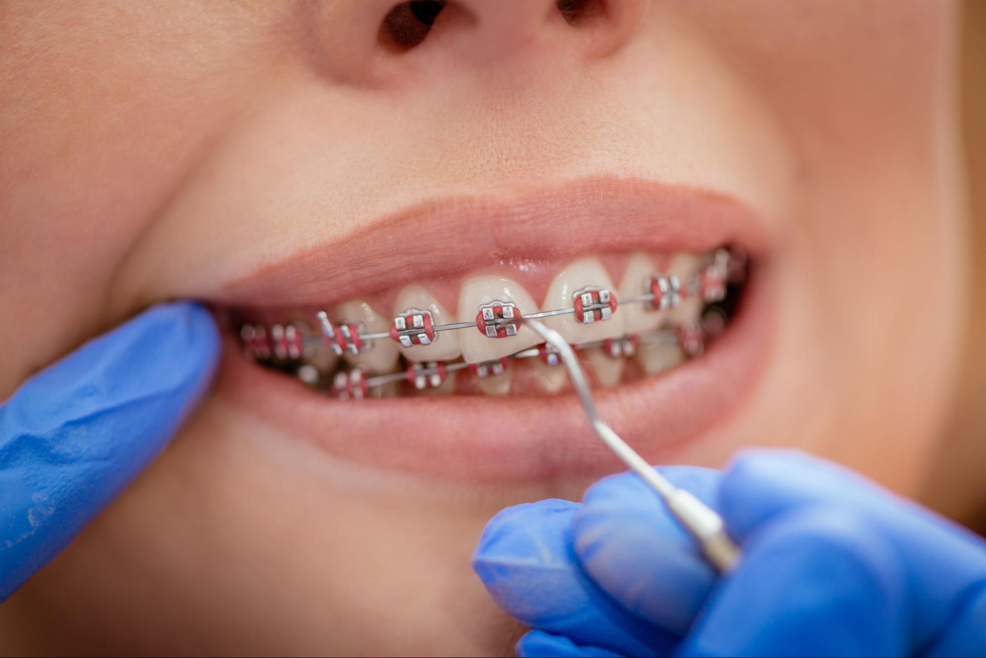 Dentist checking bracket at the braces on the female patient. Close-up