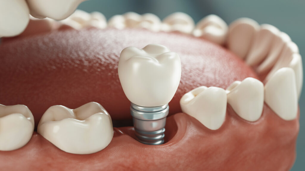 Dental implant Birmingham