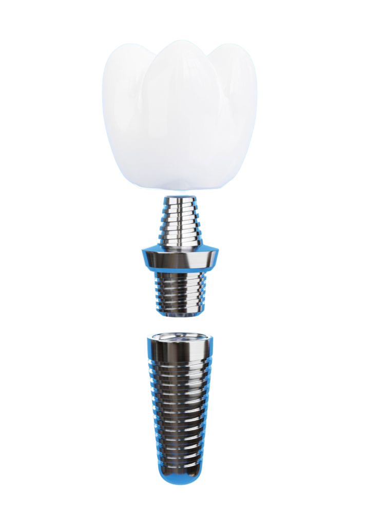 dental implants